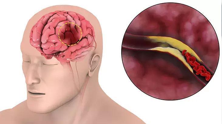 saglik bakanligi uyardi iste inme belirtileri ve yapilmasi gerekenler hTmbVYk6.jpg